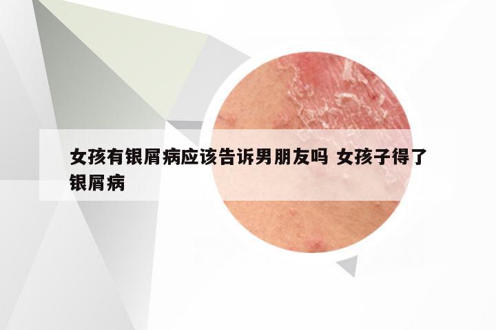 女孩有银屑病应该告诉男朋友吗 女孩子得了银屑病