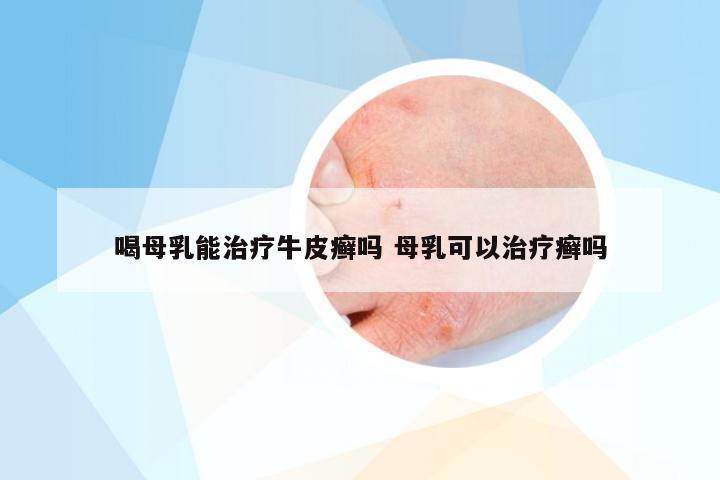 喝母乳能治疗牛皮癣吗 母乳可以治疗癣吗