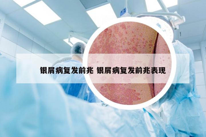 银屑病复发前兆 银屑病复发前兆表现