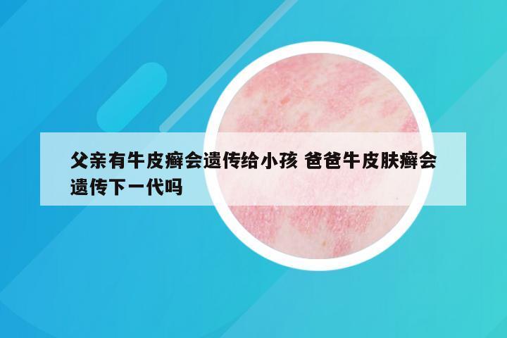父亲有牛皮癣会遗传给小孩 爸爸牛皮肤癣会遗传下一代吗