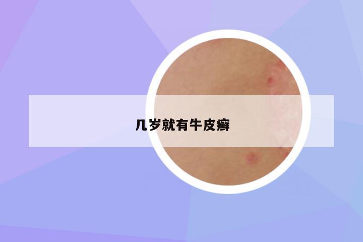 几岁就有牛皮癣