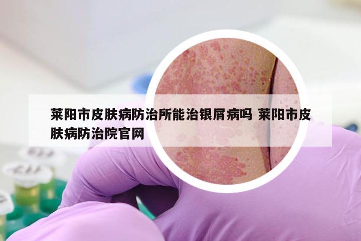 莱阳市皮肤病防治所能治银屑病吗 莱阳市皮肤病防治院官网