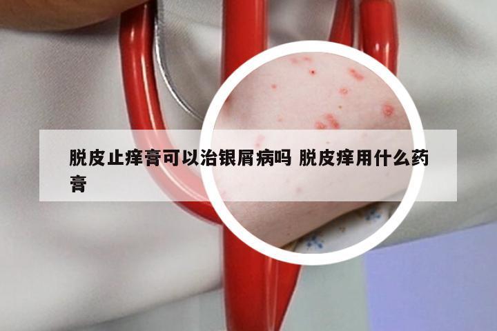 脱皮止痒膏可以治银屑病吗 脱皮痒用什么药膏