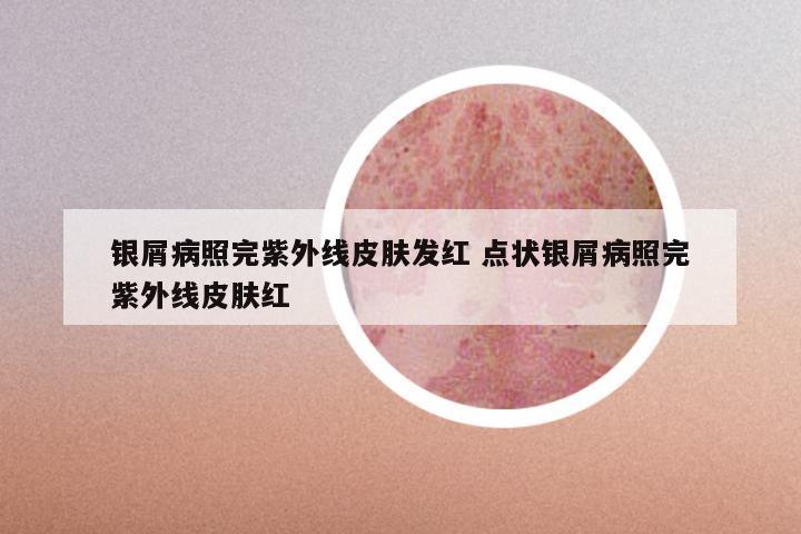 银屑病照完紫外线皮肤发红 点状银屑病照完紫外线皮肤红