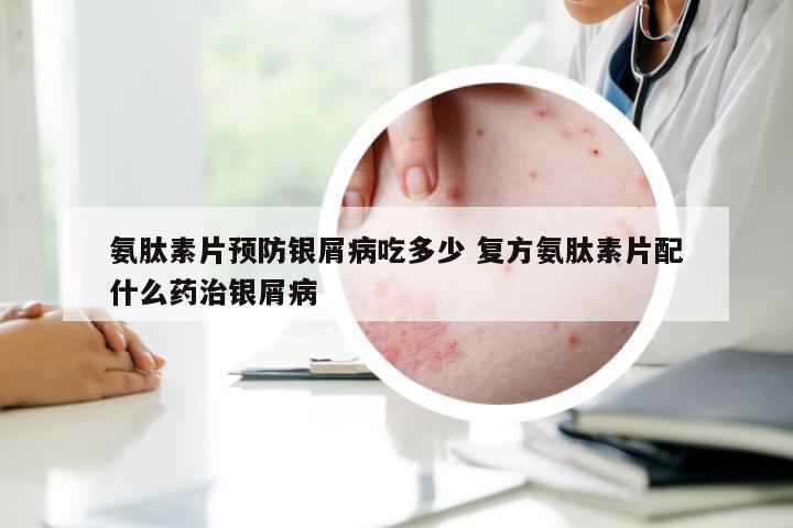 氨肽素片预防银屑病吃多少 复方氨肽素片配什么药治银屑病