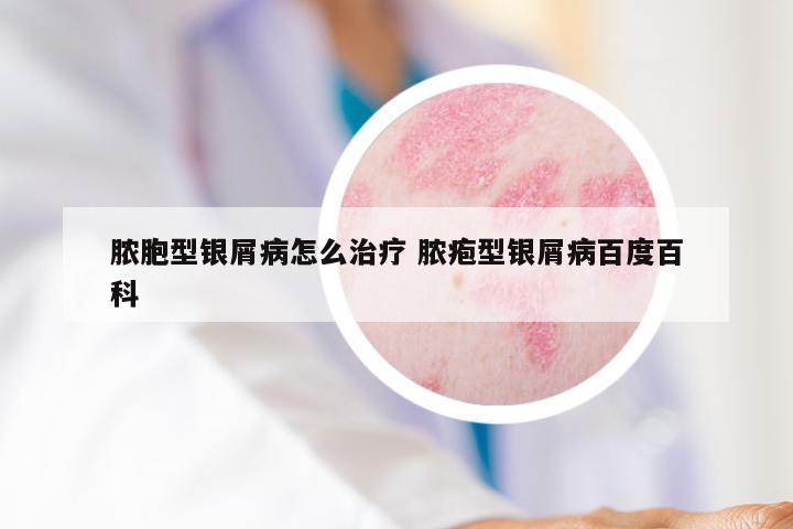 脓胞型银屑病怎么治疗 脓疱型银屑病百度百科