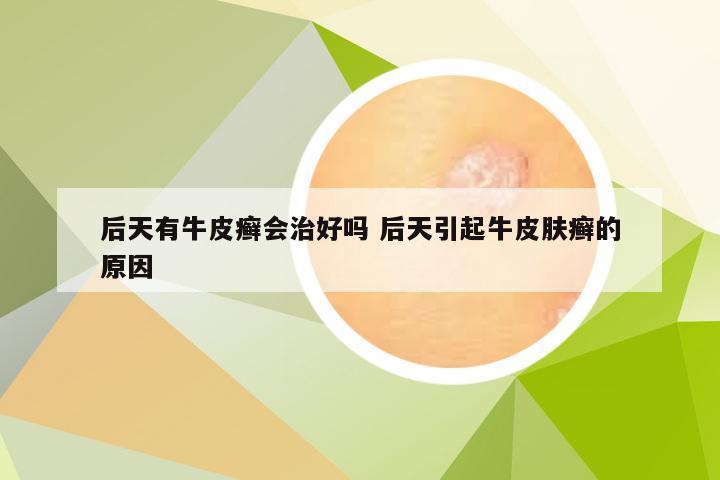 后天有牛皮癣会治好吗 后天引起牛皮肤癣的原因
