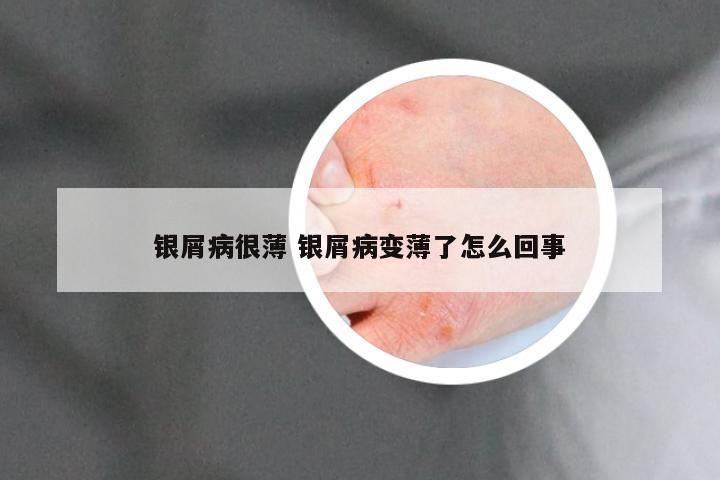 银屑病很薄 银屑病变薄了怎么回事