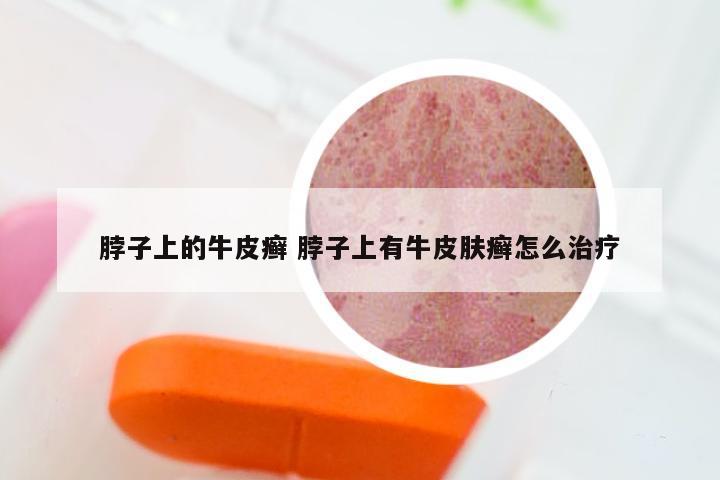 脖子上的牛皮癣 脖子上有牛皮肤癣怎么治疗