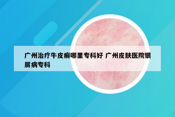 广州治疗牛皮癣哪里专科好 广州皮肤医院银屑病专科