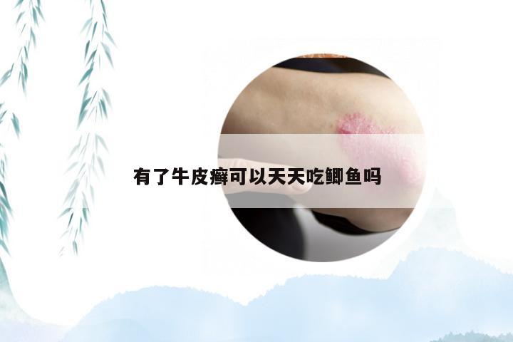 有了牛皮癣可以天天吃鲫鱼吗