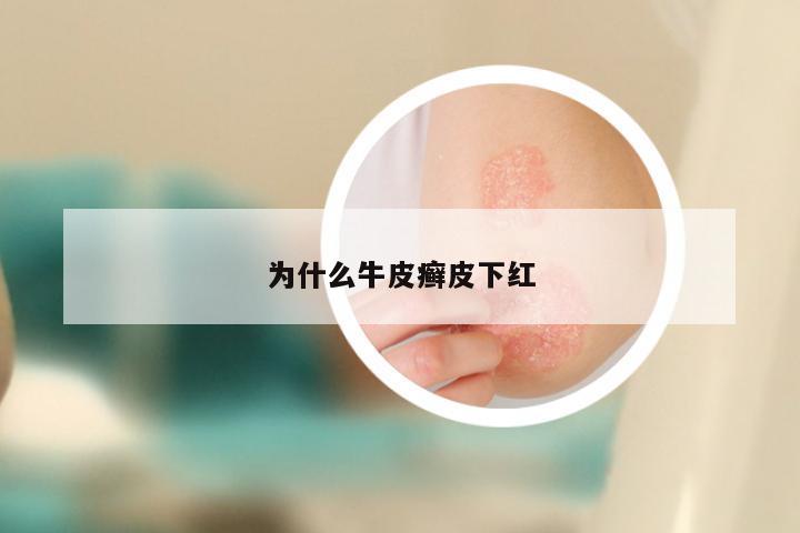 为什么牛皮癣皮下红