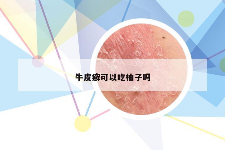 牛皮癣可以吃柚子吗