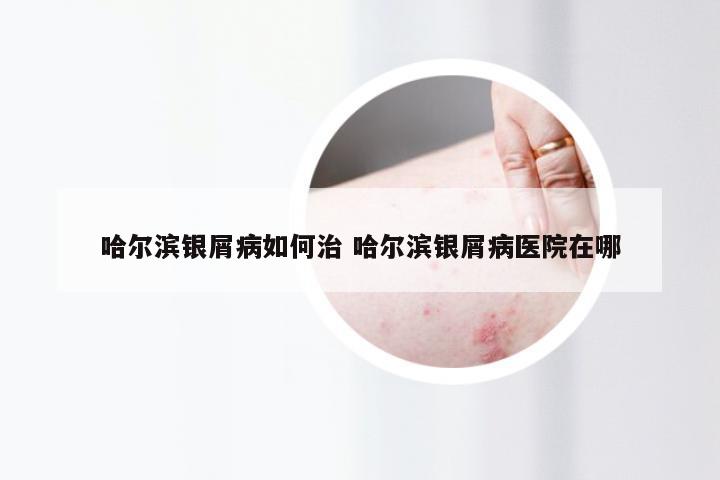哈尔滨银屑病如何治 哈尔滨银屑病医院在哪