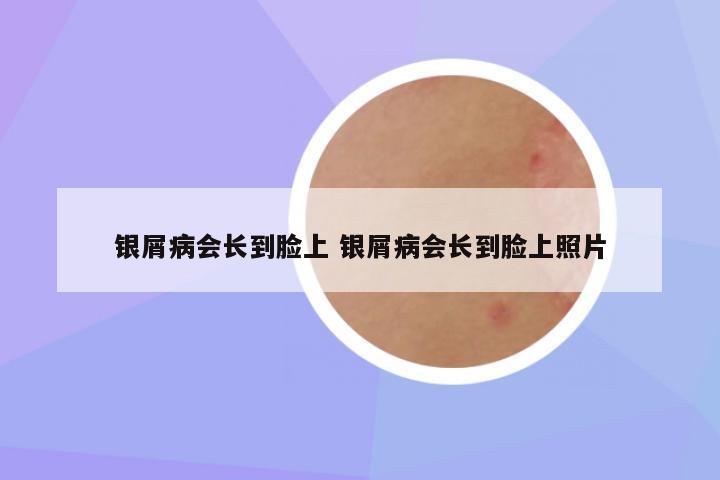 银屑病会长到脸上 银屑病会长到脸上照片