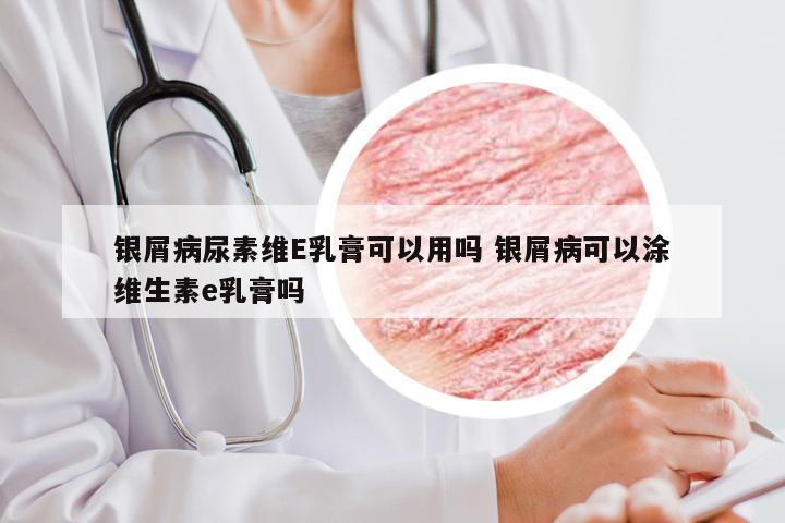 银屑病尿素维E乳膏可以用吗 银屑病可以涂维生素e乳膏吗