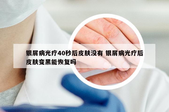 银屑病光疗40秒后皮肤没有 银屑病光疗后皮肤变黑能恢复吗