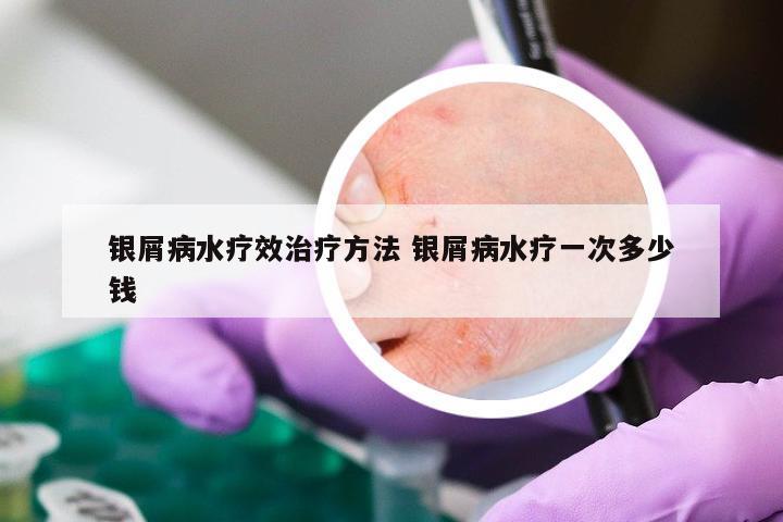 银屑病水疗效治疗方法 银屑病水疗一次多少钱