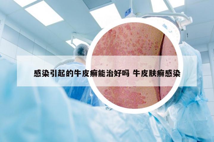 感染引起的牛皮癣能治好吗 牛皮肤癣感染