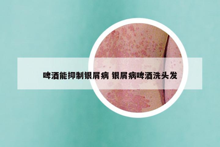 啤酒能抑制银屑病 银屑病啤酒洗头发