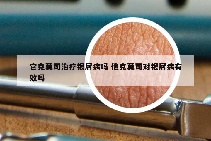 它克莫司治疗银屑病吗 他克莫司对银屑病有效吗