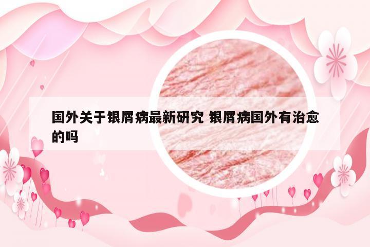 国外关于银屑病最新研究 银屑病国外有治愈的吗
