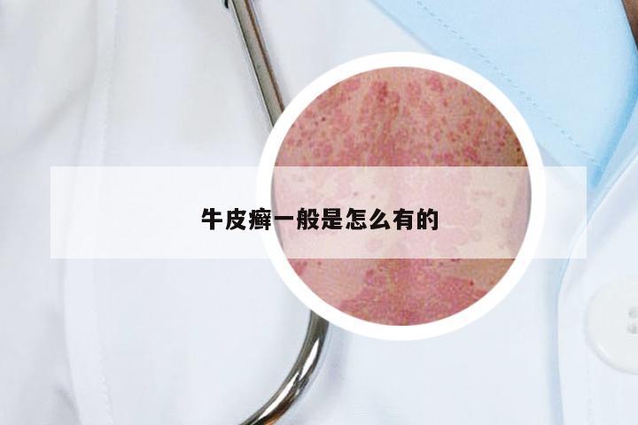 牛皮癣一般是怎么有的