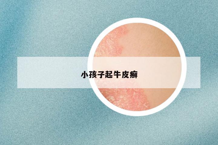 小孩子起牛皮癣