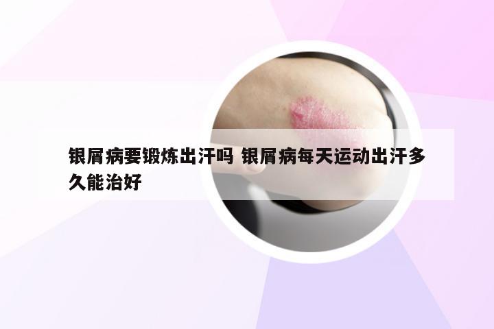 银屑病要锻炼出汗吗 银屑病每天运动出汗多久能治好