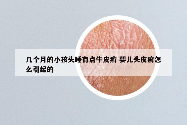 几个月的小孩头睡有点牛皮癣 婴儿头皮癣怎么引起的