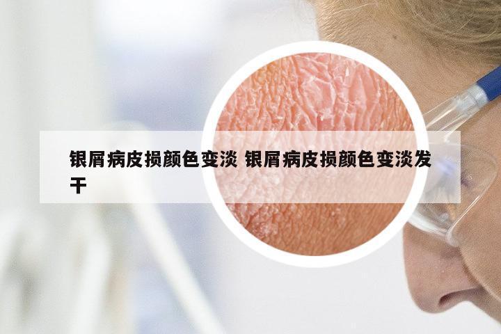 银屑病皮损颜色变淡 银屑病皮损颜色变淡发干