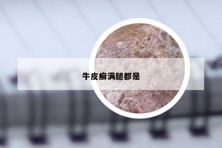 牛皮癣满腿都是