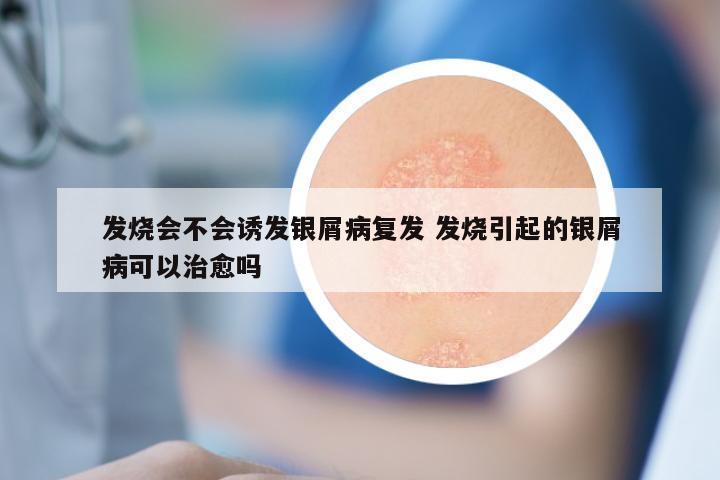 发烧会不会诱发银屑病复发 发烧引起的银屑病可以治愈吗