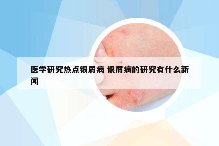 医学研究热点银屑病 银屑病的研究有什么新闻