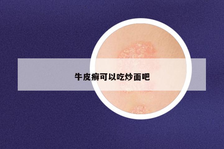 牛皮癣可以吃炒面吧