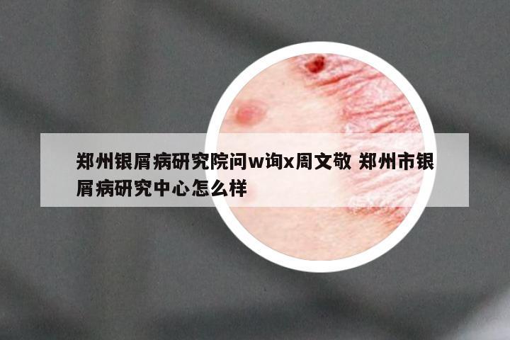 郑州银屑病研究院问w询x周文敬 郑州市银屑病研究中心怎么样