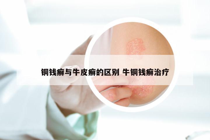 铜钱癣与牛皮癣的区别 牛铜钱癣治疗