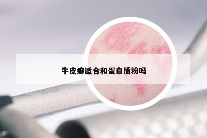 牛皮癣适合和蛋白质粉吗