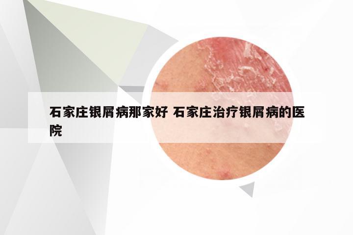 石家庄银屑病那家好 石家庄治疗银屑病的医院