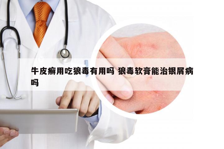 牛皮癣用吃狼毒有用吗 狼毒软膏能治银屑病吗