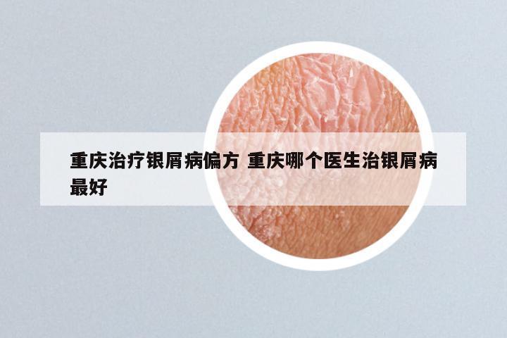 重庆治疗银屑病偏方 重庆哪个医生治银屑病最好