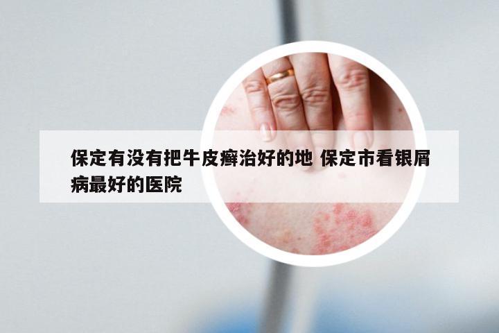 保定有没有把牛皮癣治好的地 保定市看银屑病最好的医院