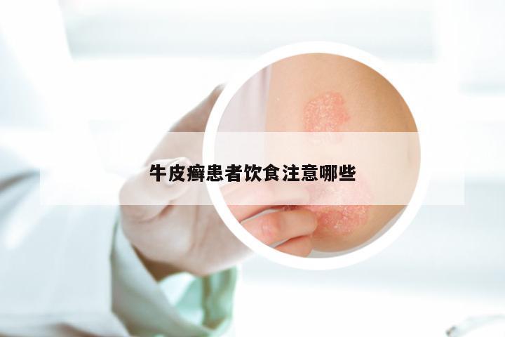 牛皮癣患者饮食注意哪些