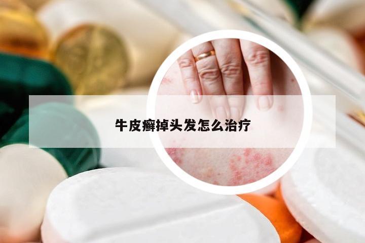 牛皮癣掉头发怎么治疗