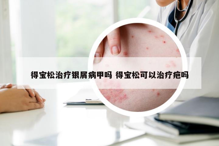 得宝松治疗银屑病甲吗 得宝松可以治疗疤吗