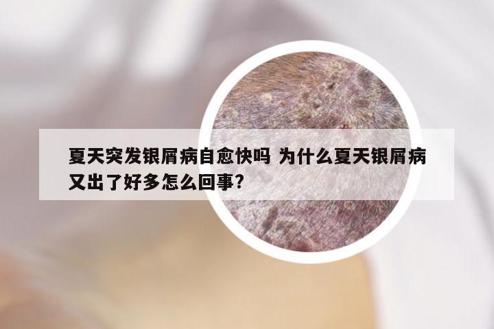 夏天突发银屑病自愈快吗 为什么夏天银屑病又出了好多怎么回事?
