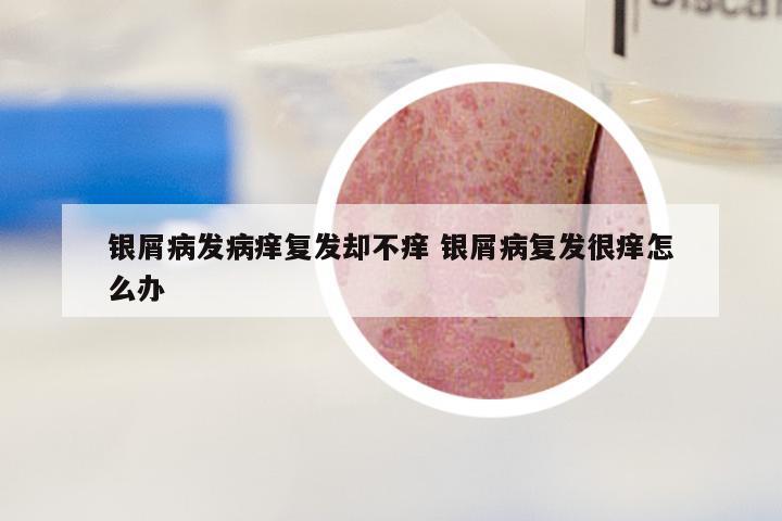 银屑病发病痒复发却不痒 银屑病复发很痒怎么办