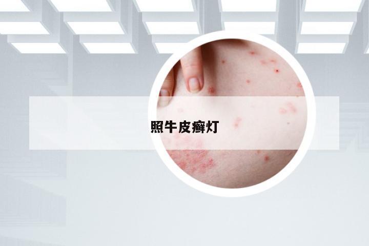 照牛皮癣灯