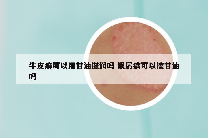 牛皮癣可以用甘油滋润吗 银屑病可以擦甘油吗