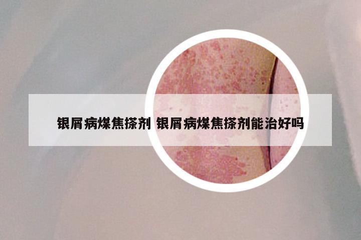 银屑病煤焦搽剂 银屑病煤焦搽剂能治好吗